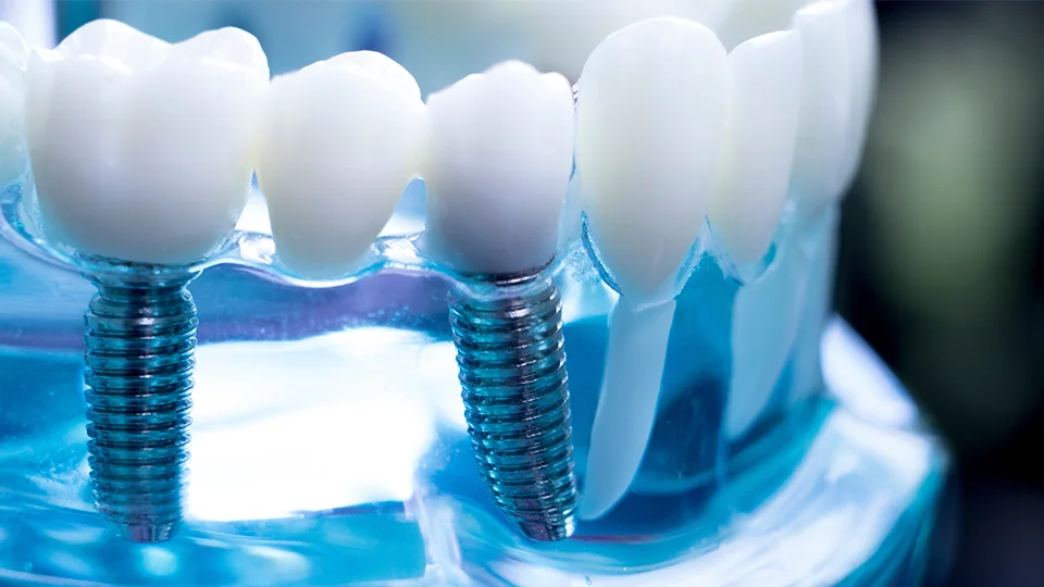 Implantat Zahnersatz